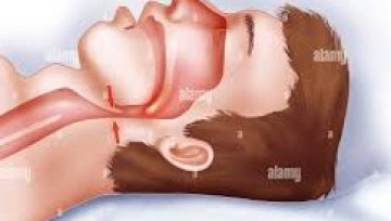 Finding Rest Again: Understanding and Managing Obstructive Sleep Apnea